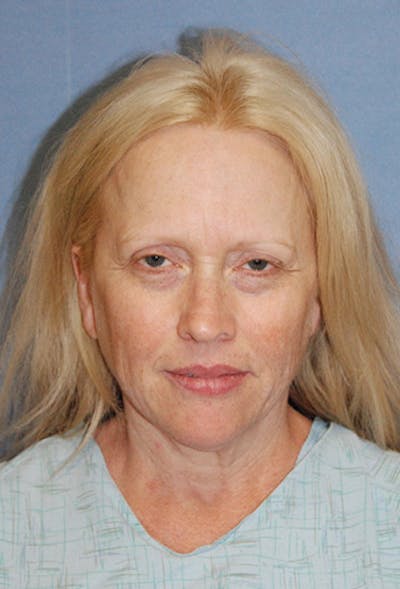 Facelift Before & After Gallery - Patient 904096 - Image 1