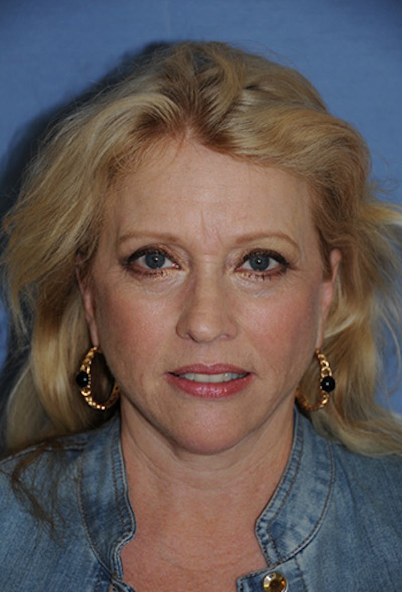 Facelift Before & After Gallery - Patient 904096 - Image 2