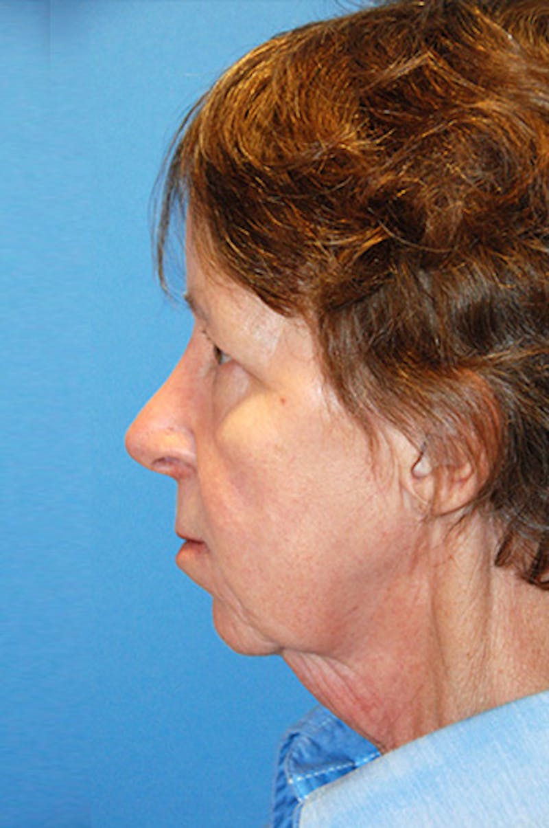 Facelift Before & After Gallery - Patient 165850 - Image 1