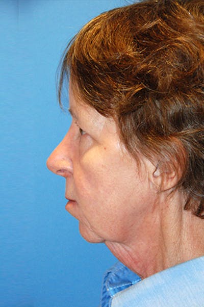 Facelift Before & After Gallery - Patient 165850 - Image 1
