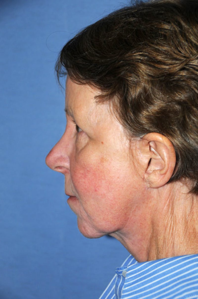 Facelift Before & After Gallery - Patient 165850 - Image 2