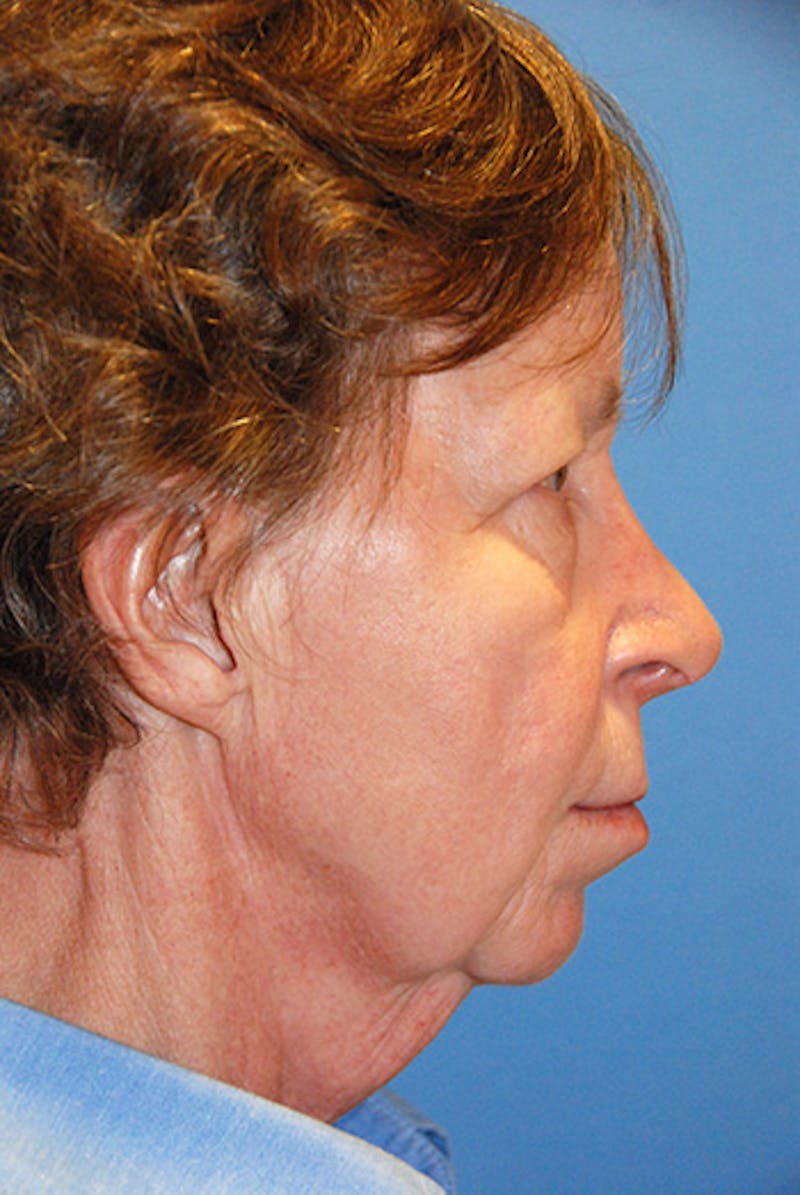 Facelift Before & After Gallery - Patient 165850 - Image 3