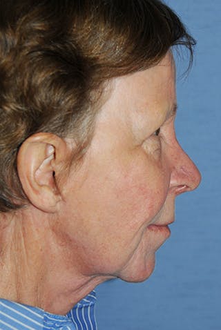Facelift Before & After Gallery - Patient 165850 - Image 4