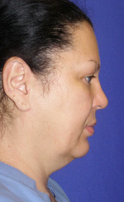 Facelift Before & After Gallery - Patient 305270 - Image 1
