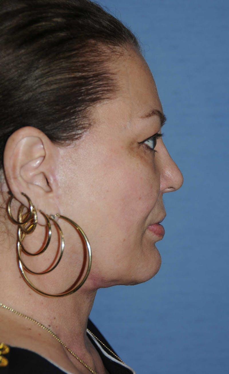 Neck Lift Before & After Gallery - Patient 134223 - Image 2