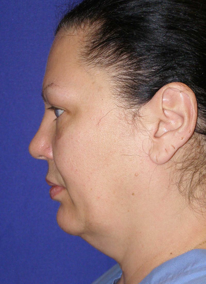 Neck Lift Before & After Gallery - Patient 134223 - Image 3