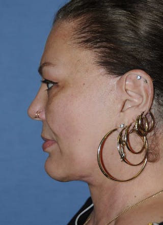 Facelift Before & After Gallery - Patient 305270 - Image 4