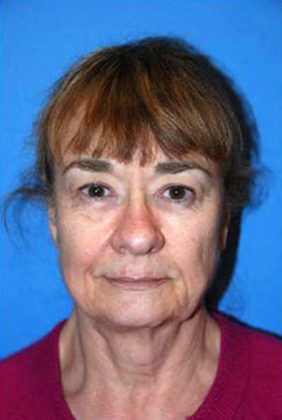 Facelift Before & After Gallery - Patient 104635 - Image 1