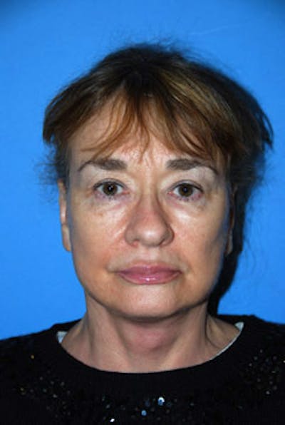 Facelift Before & After Gallery - Patient 104635 - Image 2