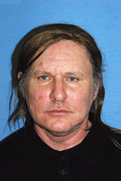 Facelift Before & After Gallery - Patient 292245 - Image 1
