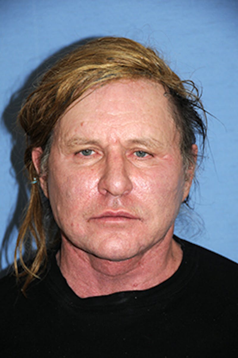 Facelift Before & After Gallery - Patient 292245 - Image 2