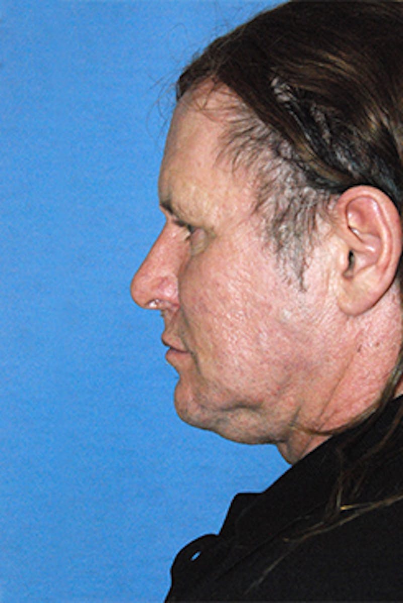 Facelift Before & After Gallery - Patient 292245 - Image 3