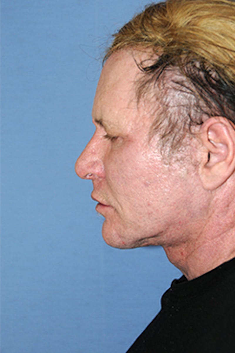 Facelift Before & After Gallery - Patient 292245 - Image 4