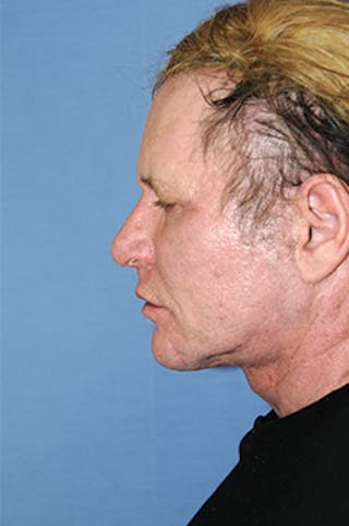 Facelift Before & After Gallery - Patient 292245 - Image 4