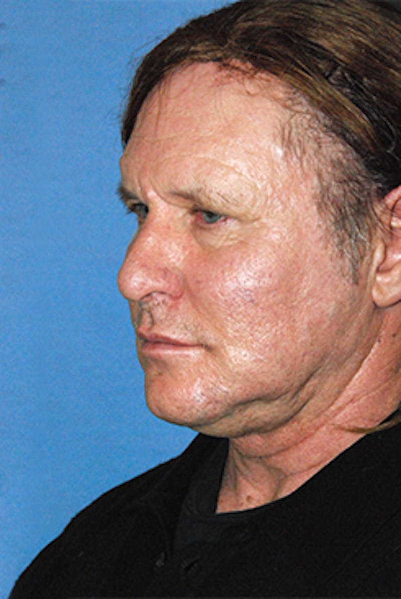 Facelift Before & After Gallery - Patient 292245 - Image 5