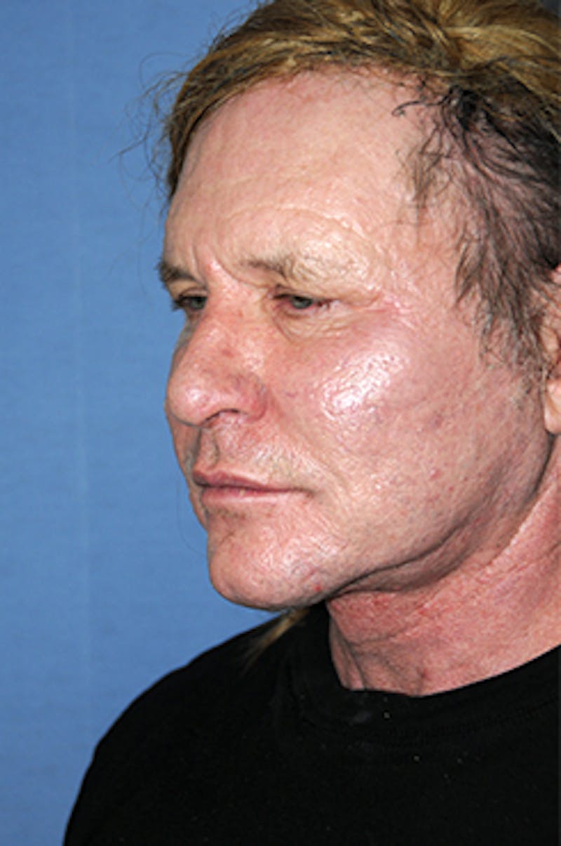 Facelift Before & After Gallery - Patient 292245 - Image 6