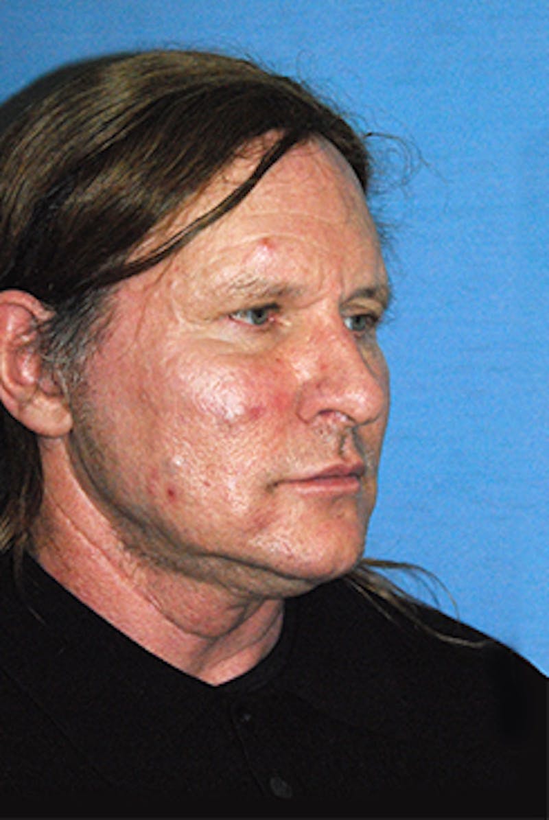 Facelift Before & After Gallery - Patient 292245 - Image 7