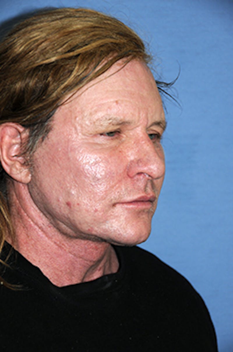Facelift Before & After Gallery - Patient 292245 - Image 8