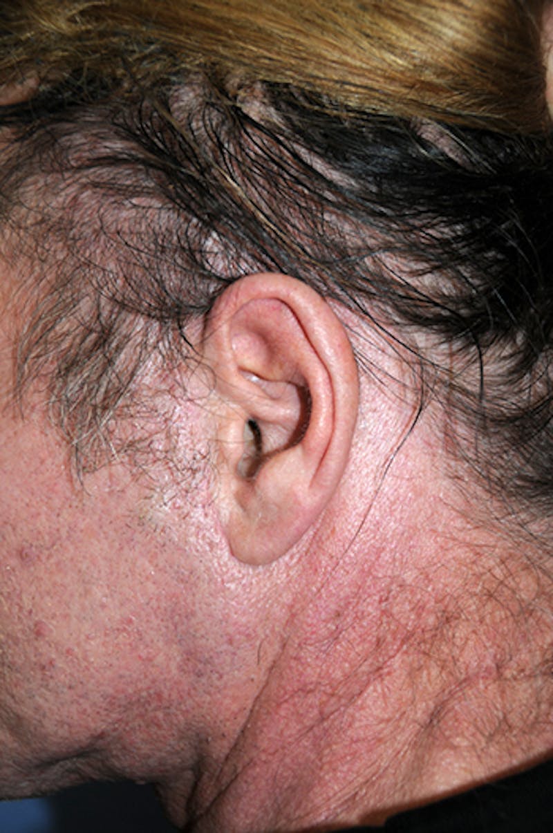 Facelift Before & After Gallery - Patient 292245 - Image 9