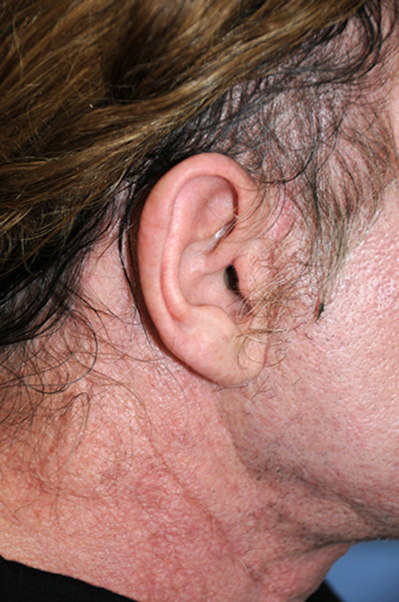 Facelift Before & After Gallery - Patient 292245 - Image 10
