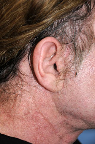 Facelift Before & After Gallery - Patient 292245 - Image 10
