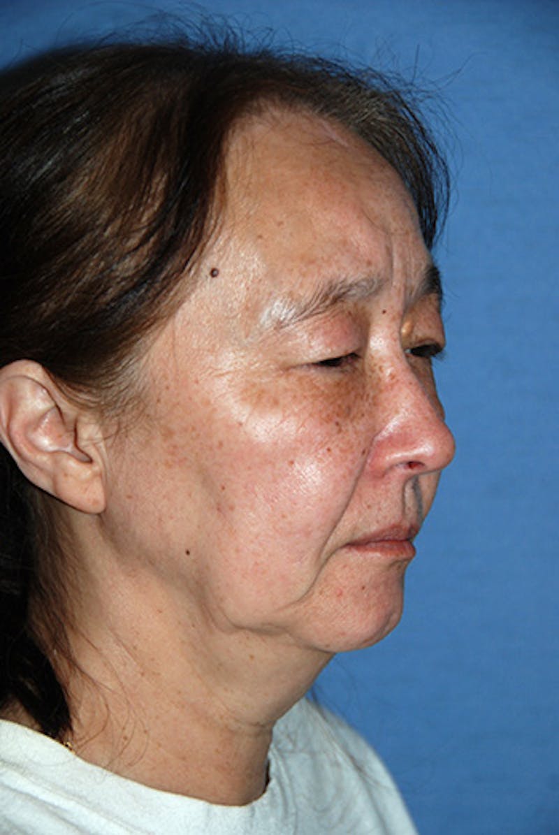 Facelift Before & After Gallery - Patient 330189 - Image 3