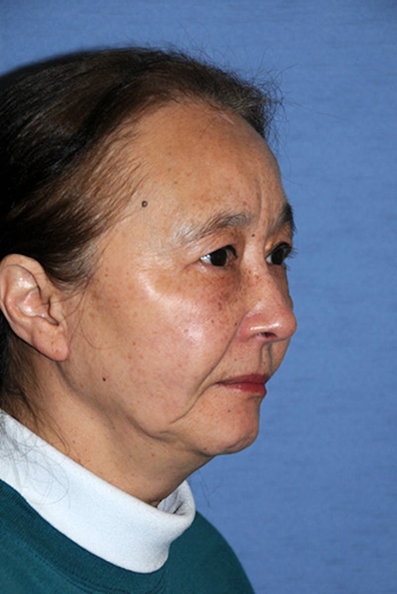 Facelift Before & After Gallery - Patient 330189 - Image 4