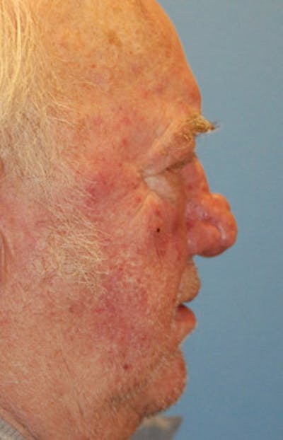 Rhinoplasty Before & After Gallery - Patient 139797 - Image 1