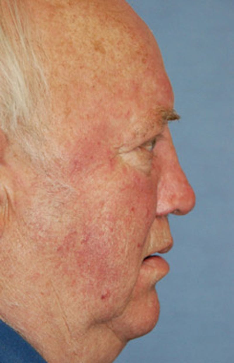 Facial Reconstruction Before & After Gallery - Patient 309995 - Image 2