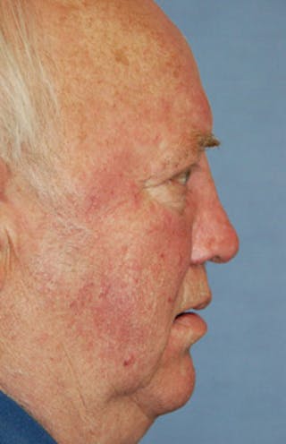Facial Reconstruction Before & After Gallery - Patient 309995 - Image 2