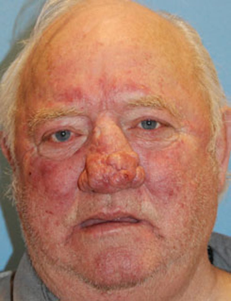 Facial Reconstruction Before & After Gallery - Patient 309995 - Image 3