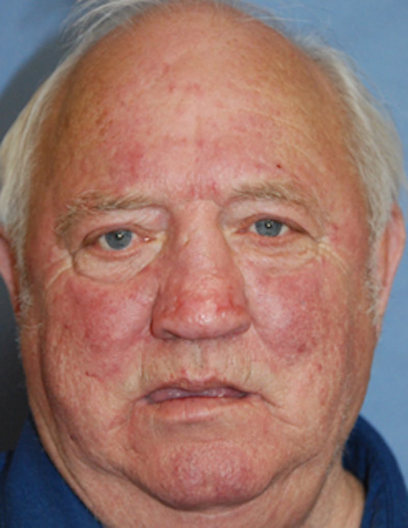 Facial Reconstruction Before & After Gallery - Patient 309995 - Image 4