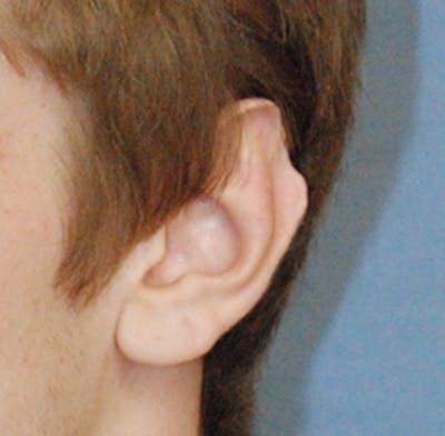 Facial Reconstruction Before & After Gallery - Patient 329824 - Image 1