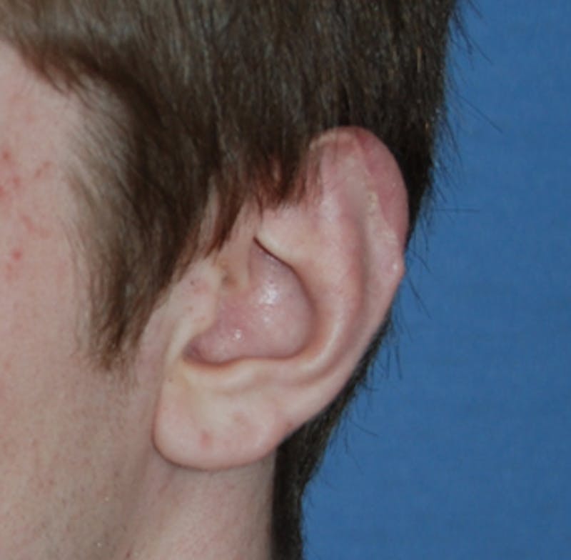 Facial Reconstruction Before & After Gallery - Patient 329824 - Image 2