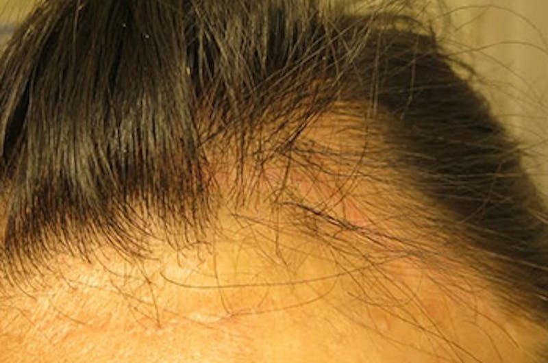 Transgender Surgery Before & After Gallery - Patient 338841 - Image 1