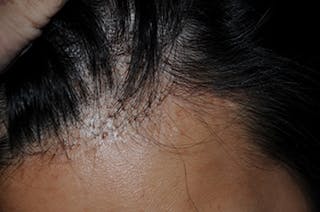 Transgender Surgery Before & After Gallery - Patient 338841 - Image 2