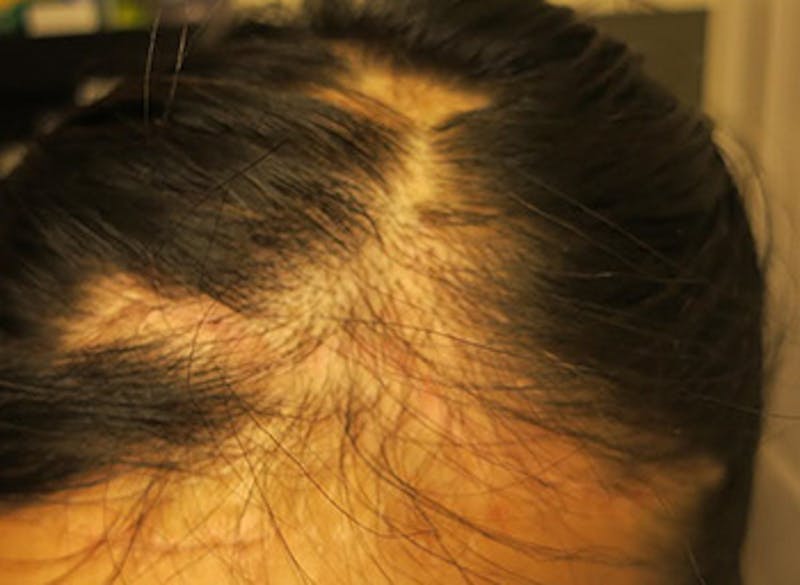 Transgender Surgery Before & After Gallery - Patient 338841 - Image 3
