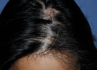 Transgender Surgery Before & After Gallery - Patient 338841 - Image 4