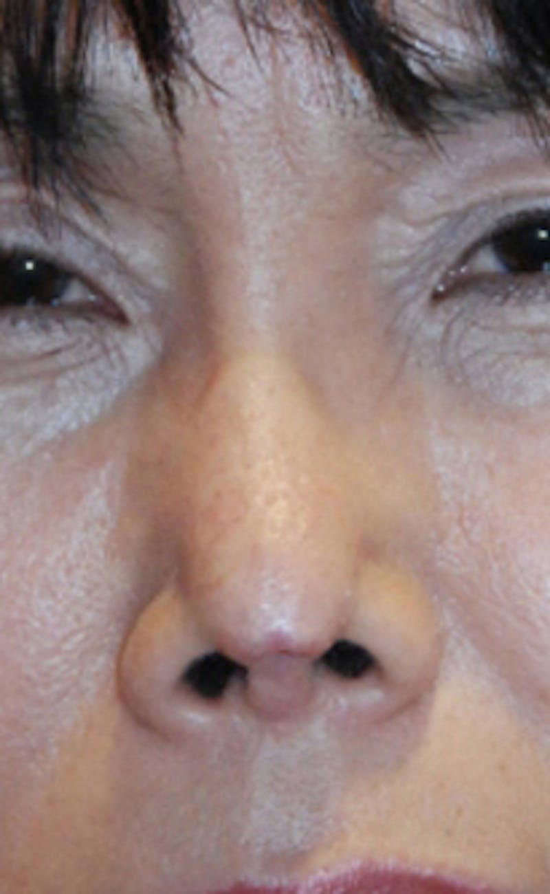Facial Reconstruction Before & After Gallery - Patient 388663 - Image 1