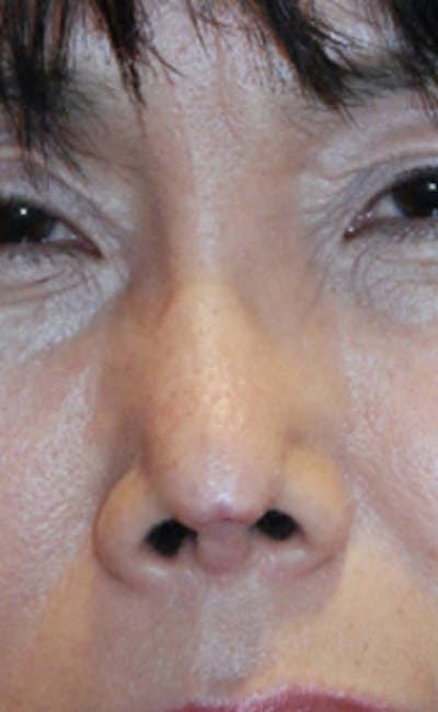 Facial Reconstruction Before & After Gallery - Patient 388663 - Image 1