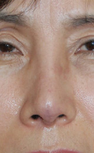 Facial Reconstruction Before & After Gallery - Patient 388663 - Image 2