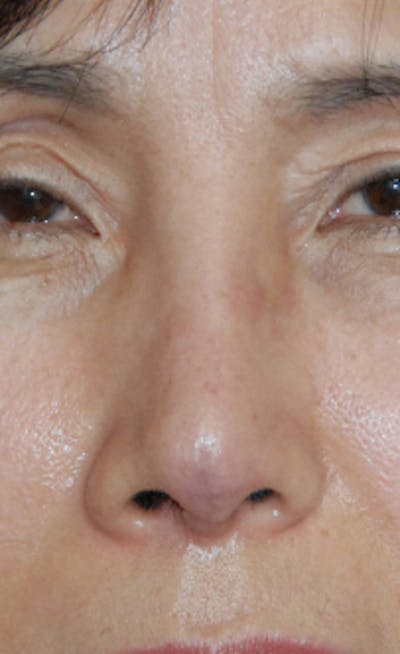 Facial Reconstruction Before & After Gallery - Patient 388663 - Image 2