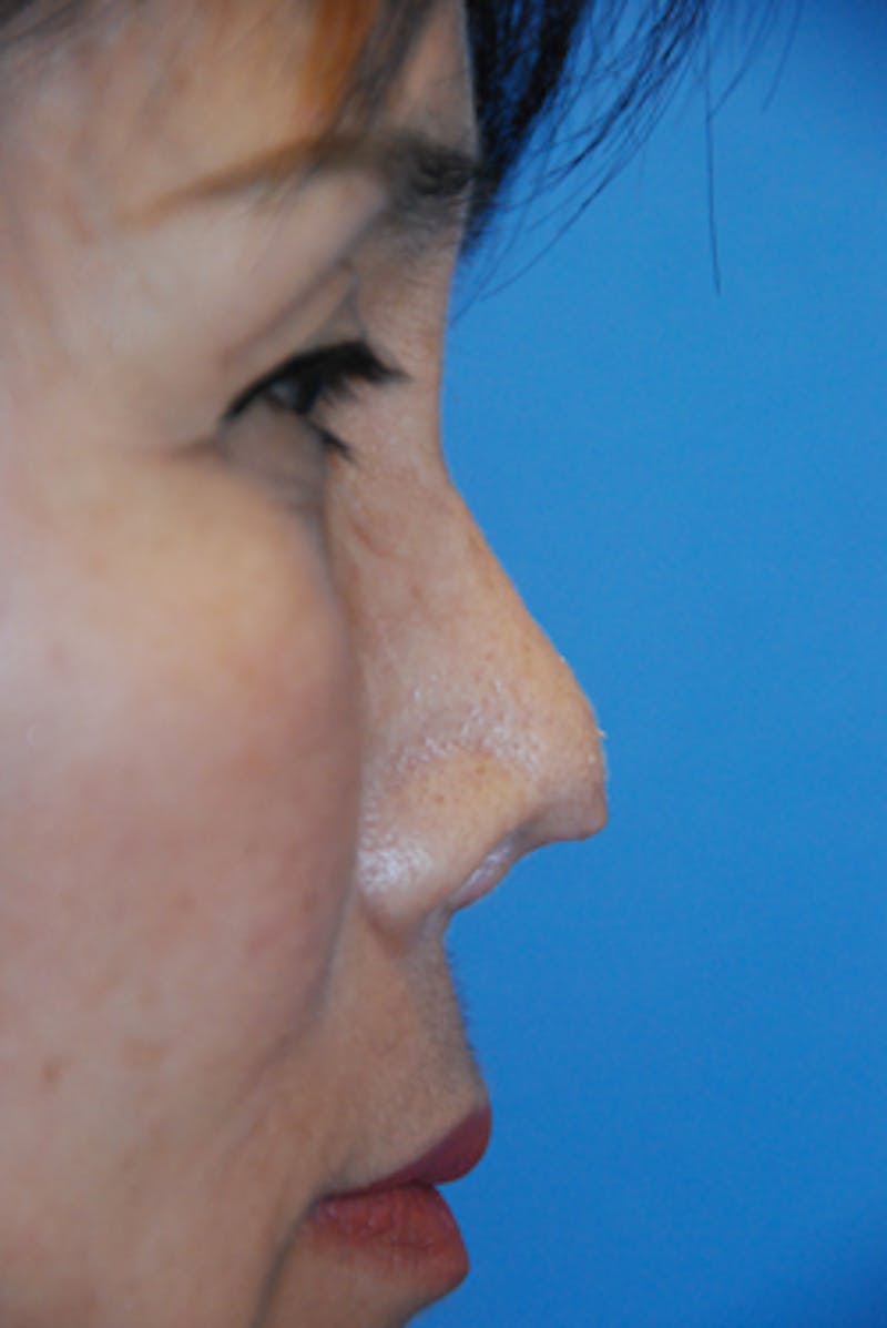 Facial Reconstruction Before & After Gallery - Patient 388663 - Image 3