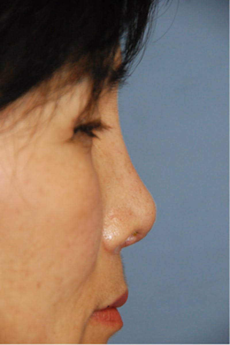 Facial Reconstruction Before & After Gallery - Patient 388663 - Image 4