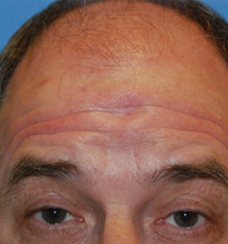 Facial Reconstruction Before & After Gallery - Patient 471586 - Image 1