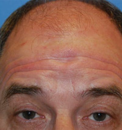 Facial Reconstruction Before & After Gallery - Patient 471586 - Image 1