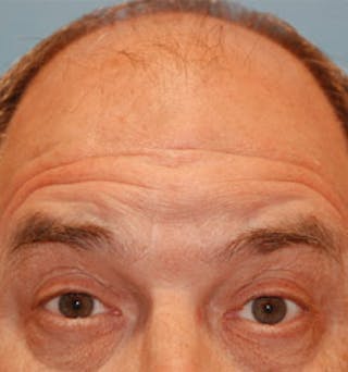 Fat Transfer Before & After Gallery - Patient 351375 - Image 2