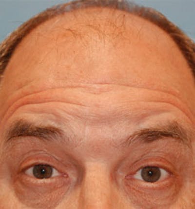 Facial Reconstruction Before & After Gallery - Patient 471586 - Image 2