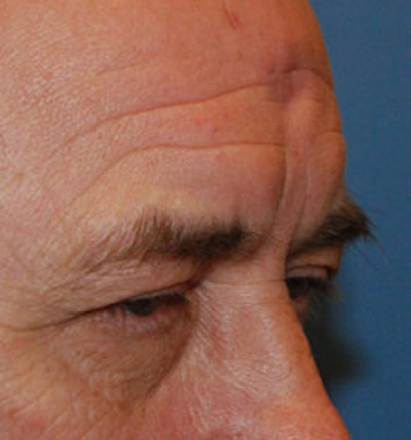 Facial Reconstruction Before & After Gallery - Patient 471586 - Image 3