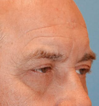Fat Transfer Before & After Gallery - Patient 351375 - Image 4